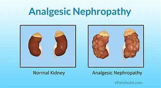 Image result for Analgesic Nephropathy