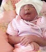 Image result for Anencephaly Baby