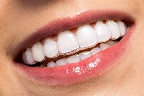 Image result for Invisible Line Braces