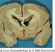 Image result for Lissencephaly Real Brain