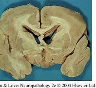 Image result for Types of Lissencephaly
