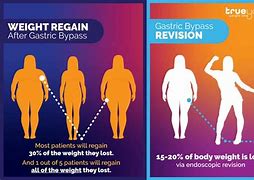 Image result for What Is a Mini Gastric Bypass