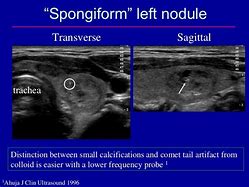 Image result for Spongiform Nodule Ultrasound