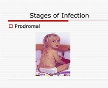 Image result for Molluscum Contagiosum Stages of Infection