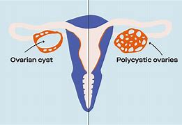 Image result for Ovarian Cancer and Pcos Color