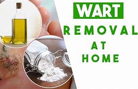 Image result for Remove Warts