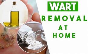 Image result for Wart Removal at Home