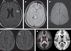 Image result for Mild Traumatic Brain Injury
