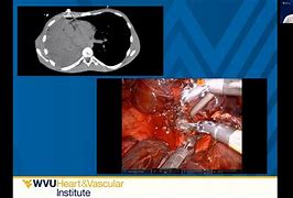 Image result for VATS Lung Surgery