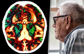 Image result for Crystallized Brain Dementia