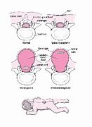 Image result for Neural Tube Defects Spina Bifida