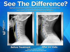 Image result for Chiropractor Back Before and After