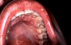 Image result for Papilloma Wart Tongue