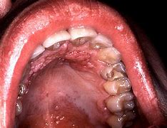 Image result for Tongue Warts Pictures