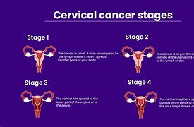 Image result for Cervical Melanoma Cancer