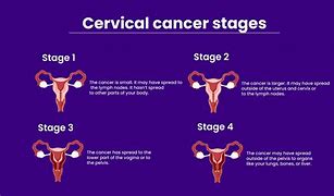 Image result for Symptoms of Cervical