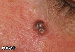 Image result for Pigmented Basal Cell Carcinoma On Black Skin