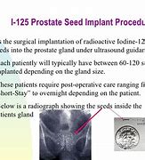 Image result for Prostate Radioactive Seed Implant