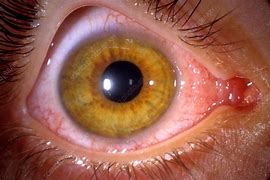 Image result for Chlamydia Trachomatis Eyes