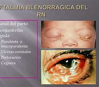 Image result for blenorragia