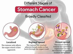 Image result for Stomach Tumor Size Chart