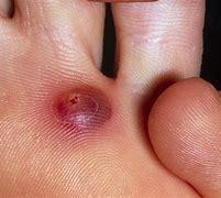 Image result for Blister Infection