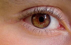 Image result for Eyelid Wart