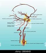Image result for Clogged Artery in Neck