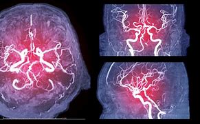 Image result for Cerebral Angiography