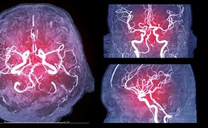 Image result for Angiogram Wound