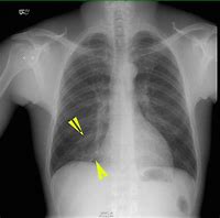 Image result for Chest X-ray Right Middle Lobe Pneumonia