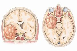 Image result for Olfactory Groove Meningioma