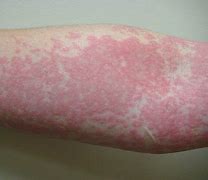 Image result for Egg Allergy Skin Rash