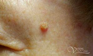 Image result for Papilloma Images