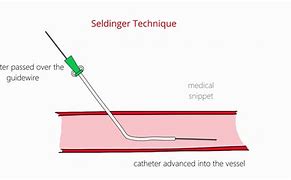 Image result for Seldinger Technique for Ascites