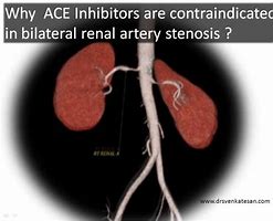 Image result for Bilateral Renal Artery Stenosis