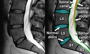 Image result for Nerve Compression of Lumbar Spine