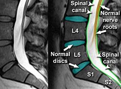 Image result for S3 S4 Spine