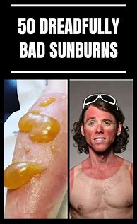 Image result for Bad Sunburn Funny