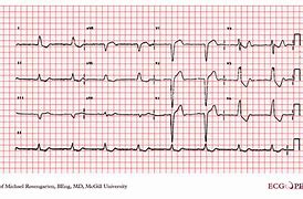 Image result for Bundle Branch Block