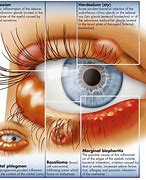 Image result for Common Eyelid Growths