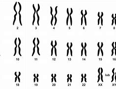 Image result for co_to_za_zespół_Łamliwego_chromosomu_x