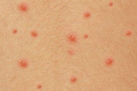 Image result for Mild Chicken pox