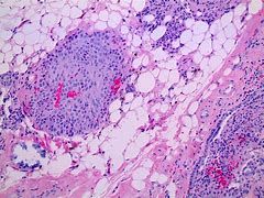 Image result for Carcinoid Tumor Electron Microscopy