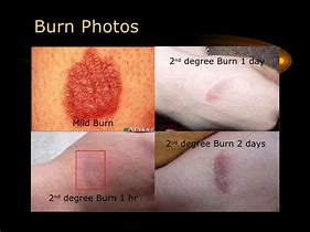 Image result for First 1st Degree Burn