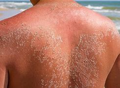 Image result for Beach Sun Burn Treatment