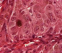 Image result for carcinoma_hepatocellulare