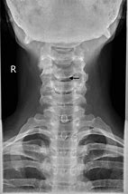 Image result for Diagram of Cervical Spine