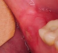 Image result for Infected Jaw Bone Removed