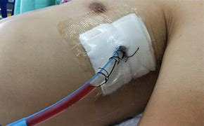 Image result for Patient with Chest Tube